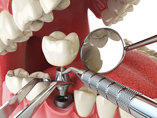 Best Emergency Root Canal Therapy in St Clair Shores, MI